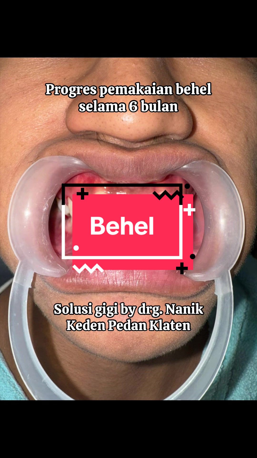 @drg Nanik MARS Keden Pedan