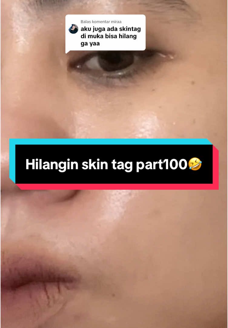 @Penghilangtahilalat.kaq.ay