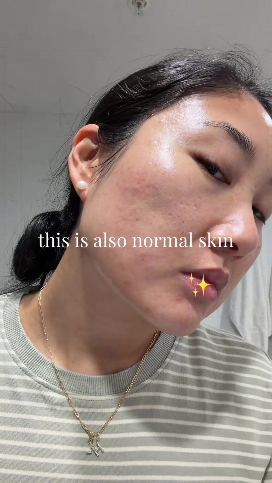 @Lisa | acne &rarr; clear skin