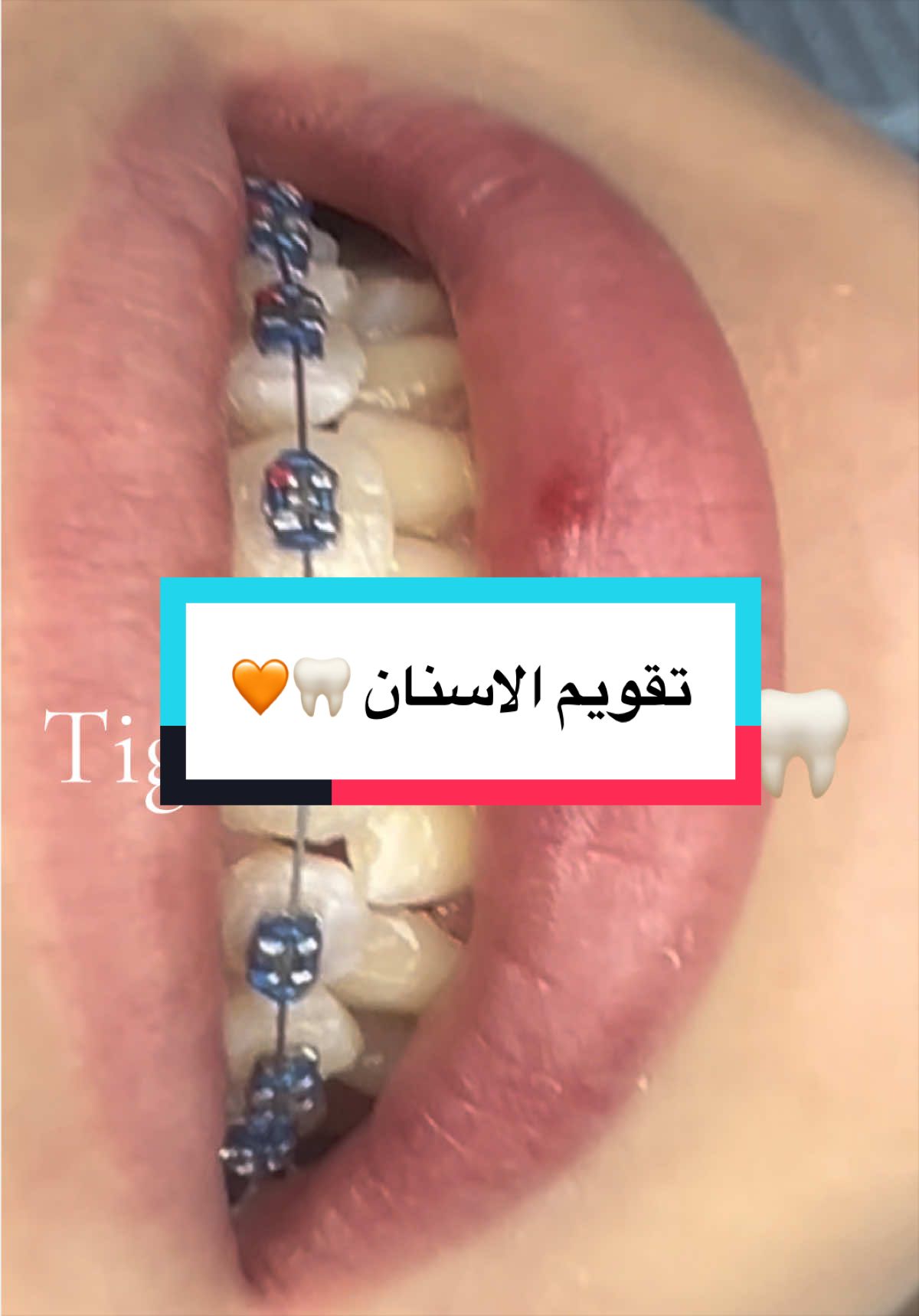 @tighlit_dentiste🦷