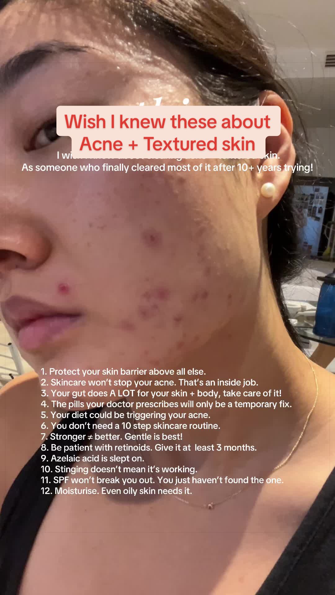 @Lisa | acne → clear skin