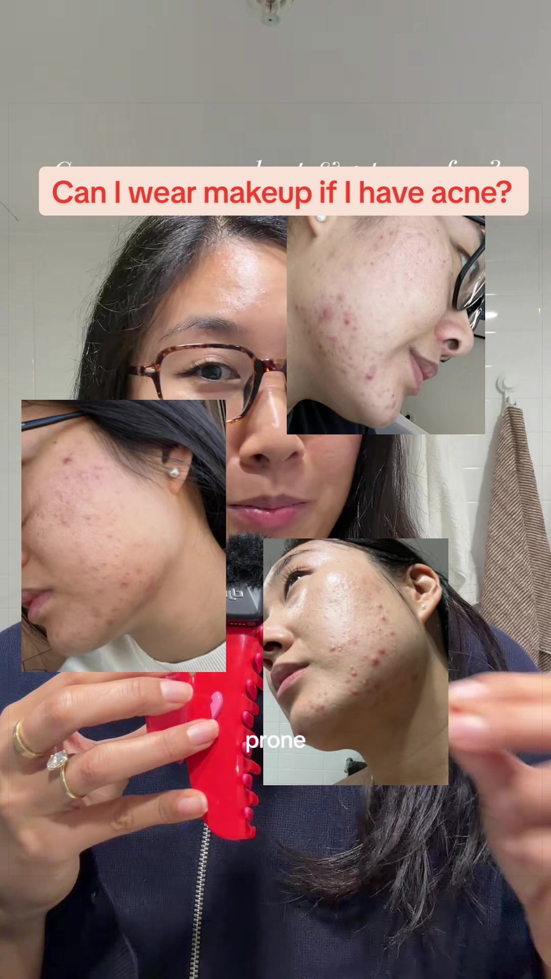 @Lisa | acne → clear skin