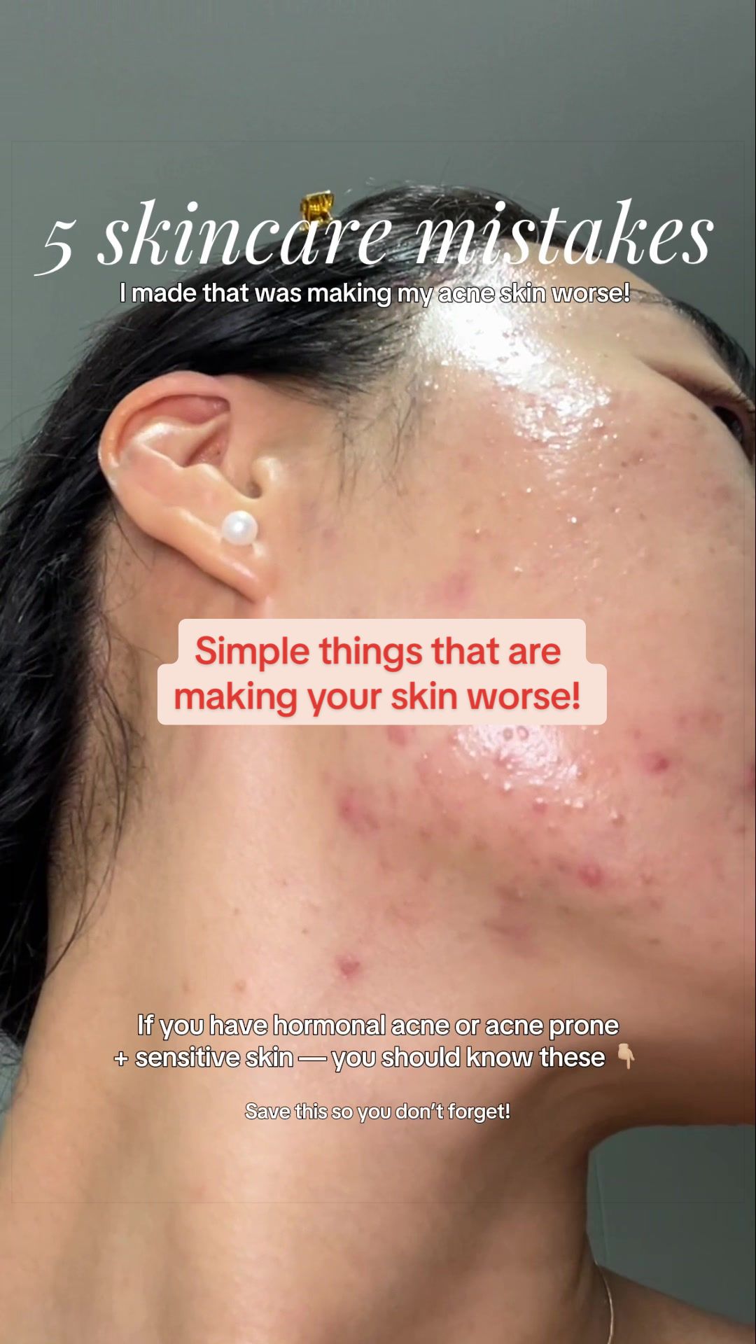 @Lisa | acne → clear skin