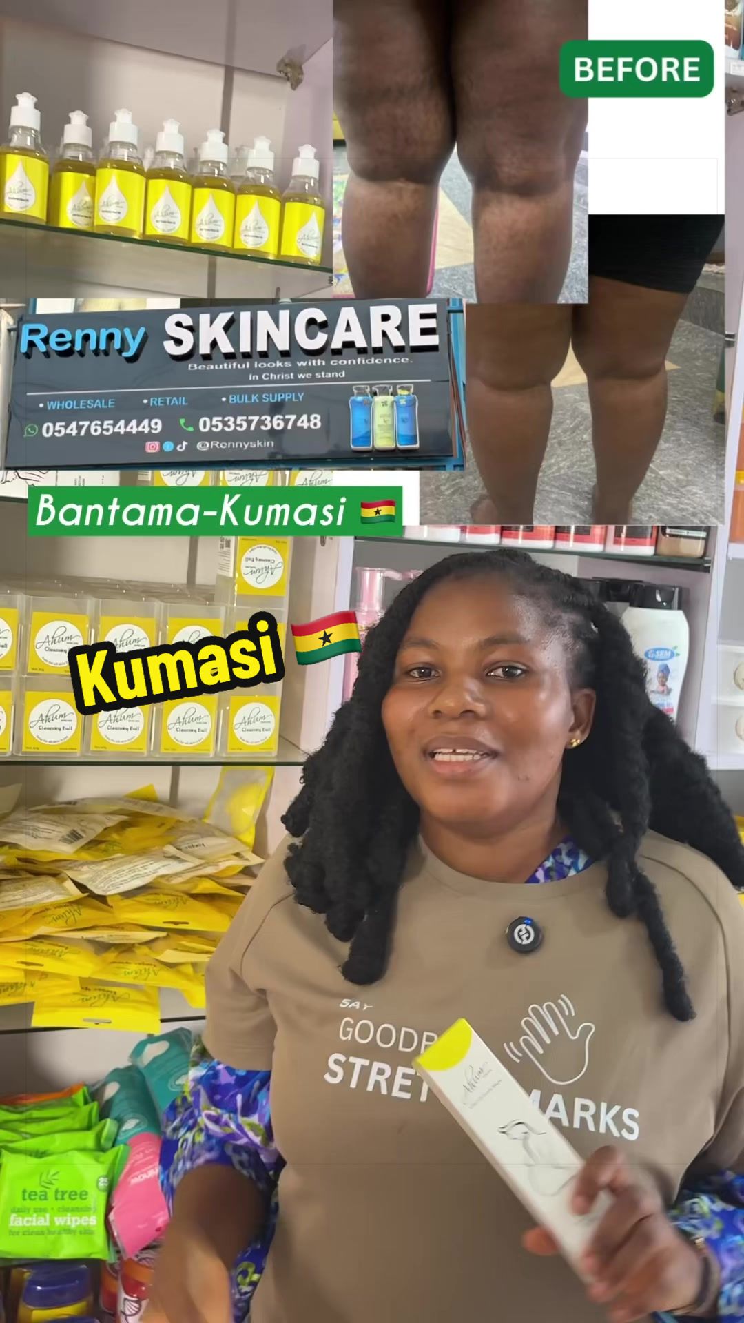 @No1 STRETCH MARKS PRODUCT