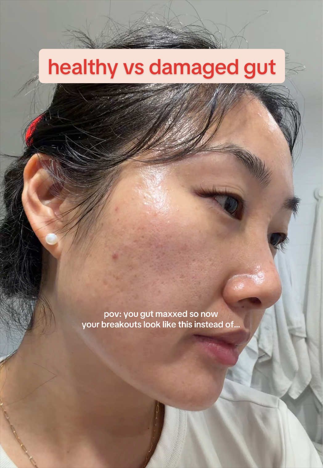 @Lisa | acne → clear skin