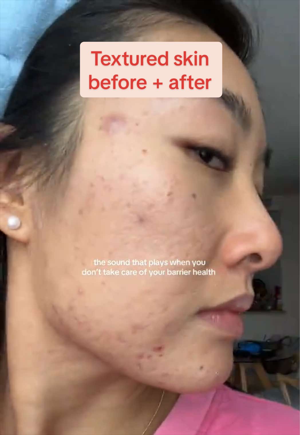 @Lisa | acne → clear skin