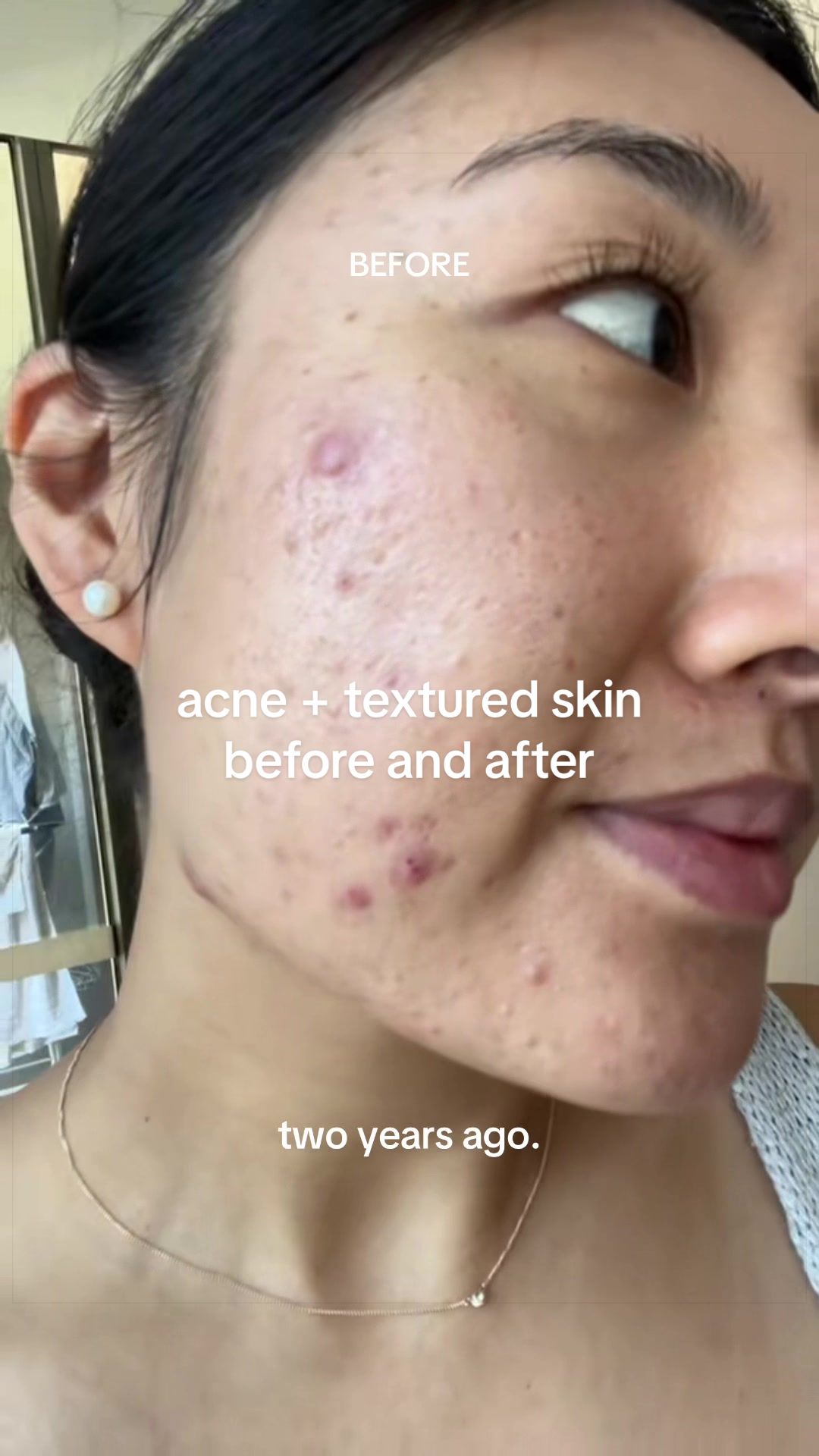 @Lisa | acne &rarr; clear skin