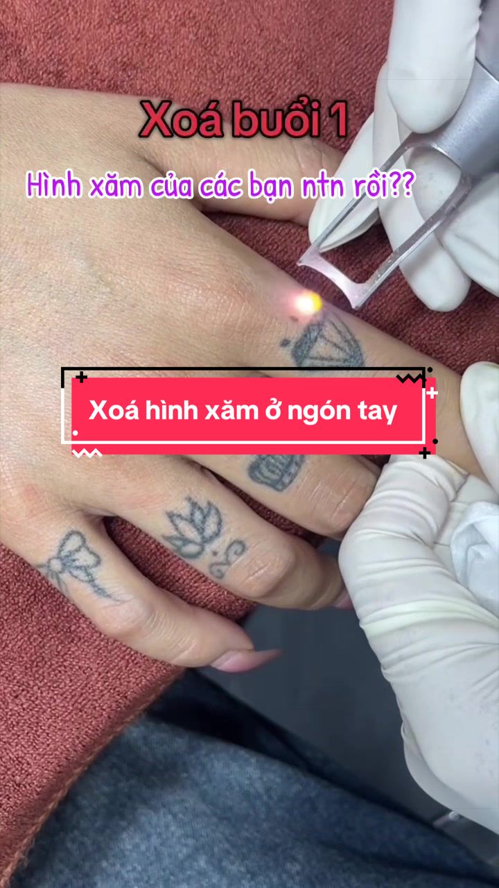 @Xo&aacute; xăm k sẹo H&agrave; Nội💧