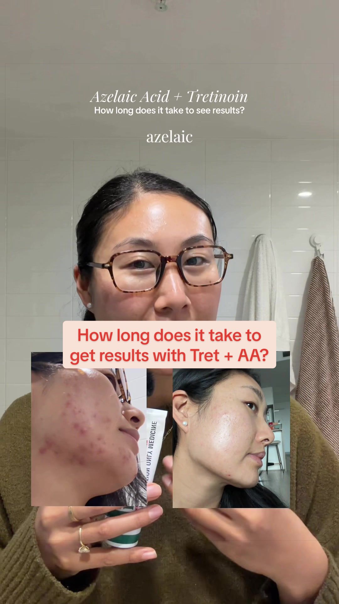 @Lisa | acne → clear skin