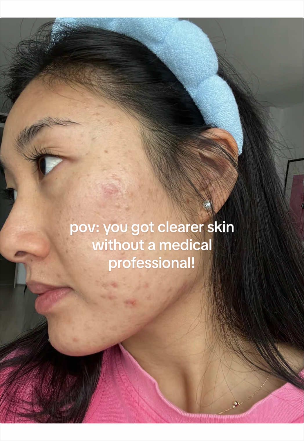 @Lisa | acne → clear skin