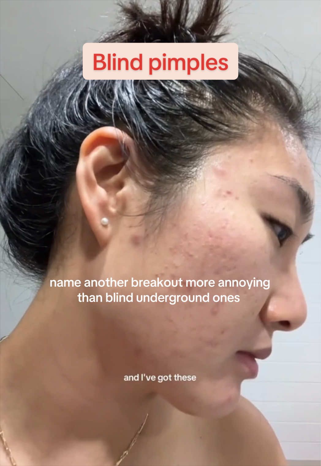 @Lisa | acne &rarr; clear skin