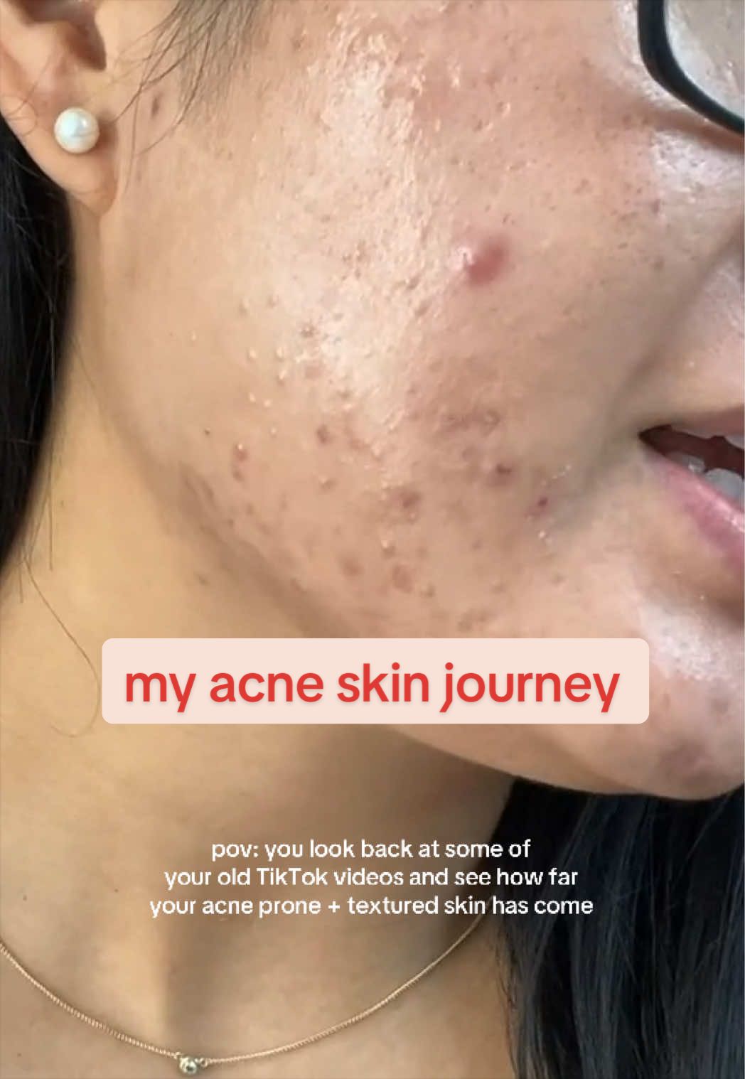 @Lisa | acne &rarr; clear skin