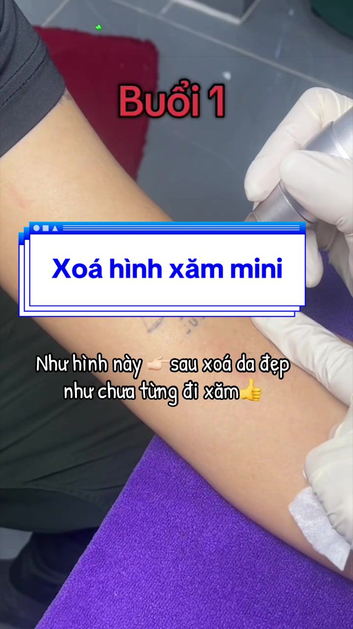 @Xo&aacute; xăm k sẹo H&agrave; Nội💧