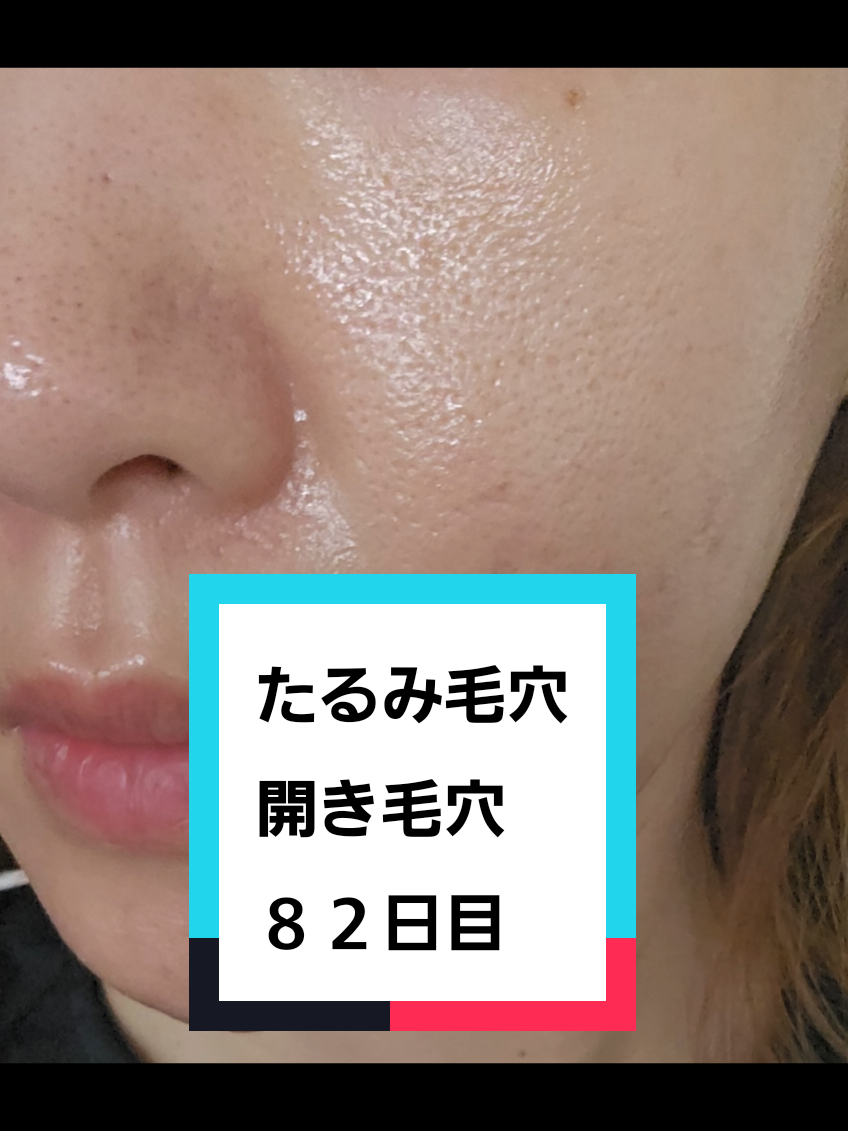@リアル毛穴改善記録