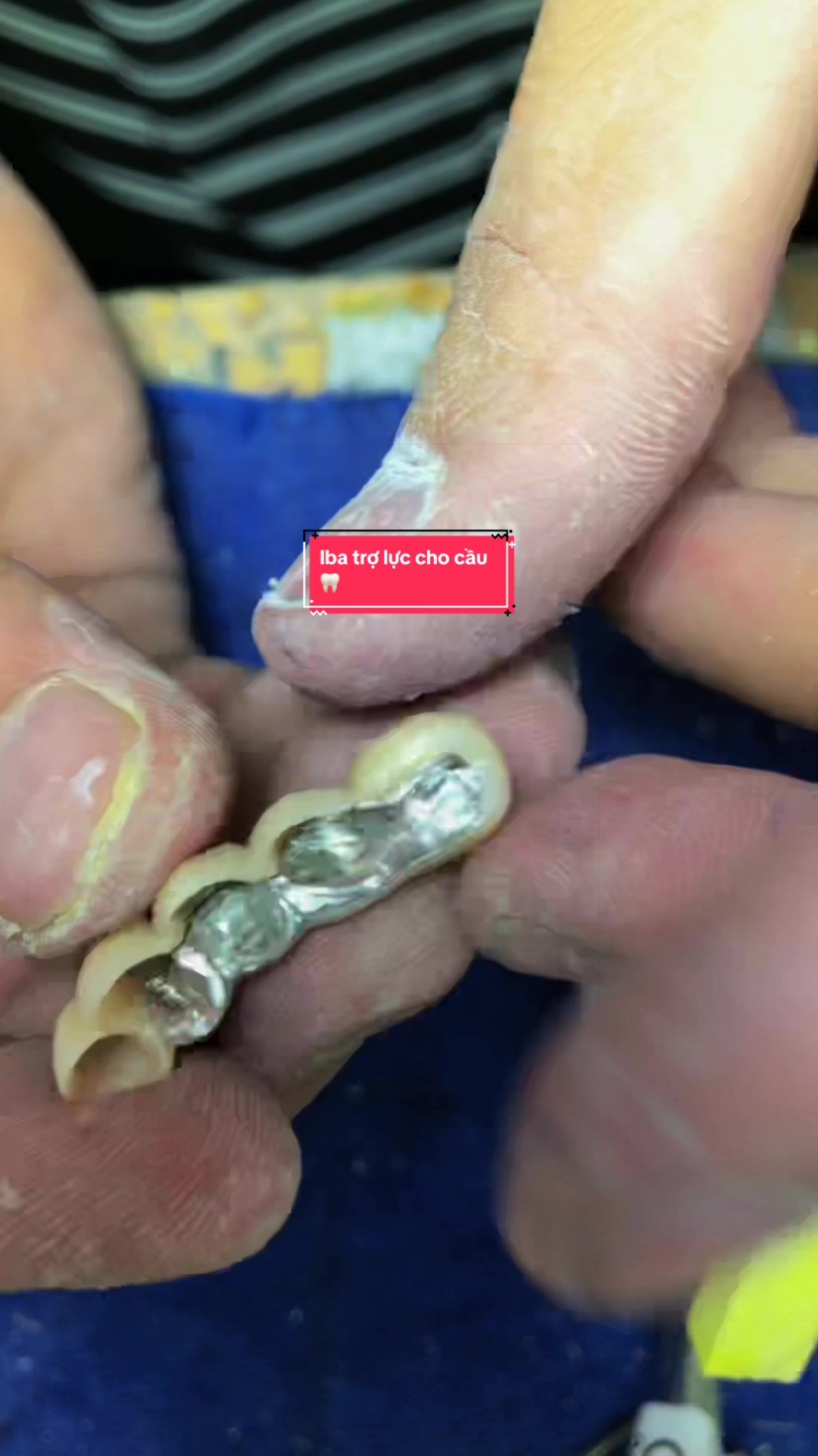 @Hùng răng sứ 🦷🦷