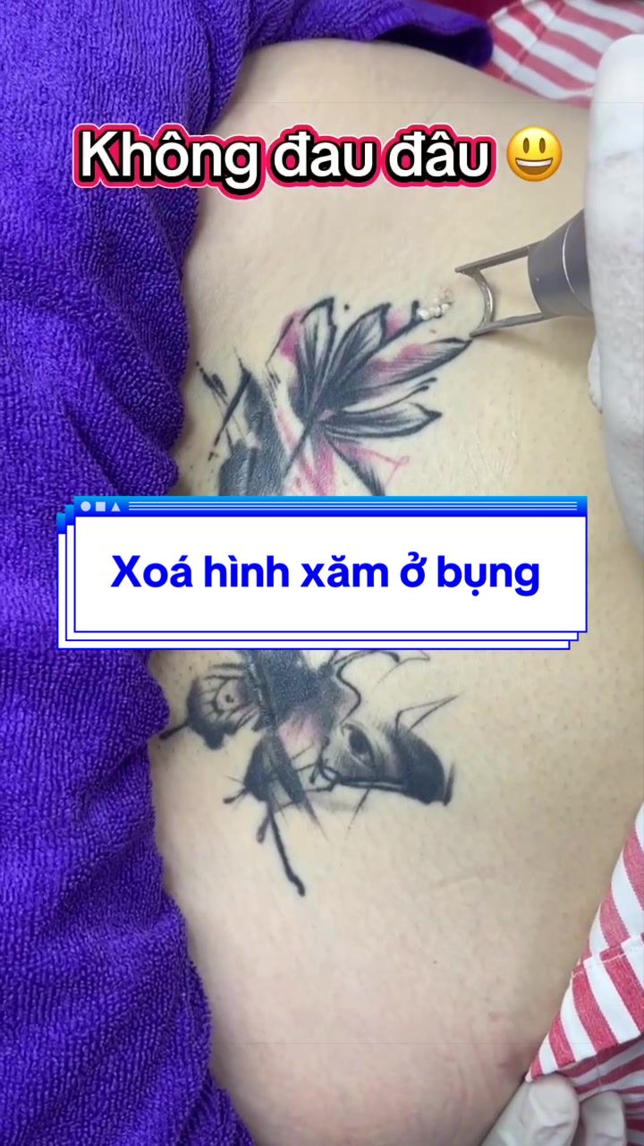 @Xo&aacute; xăm k sẹo H&agrave; Nội💧
