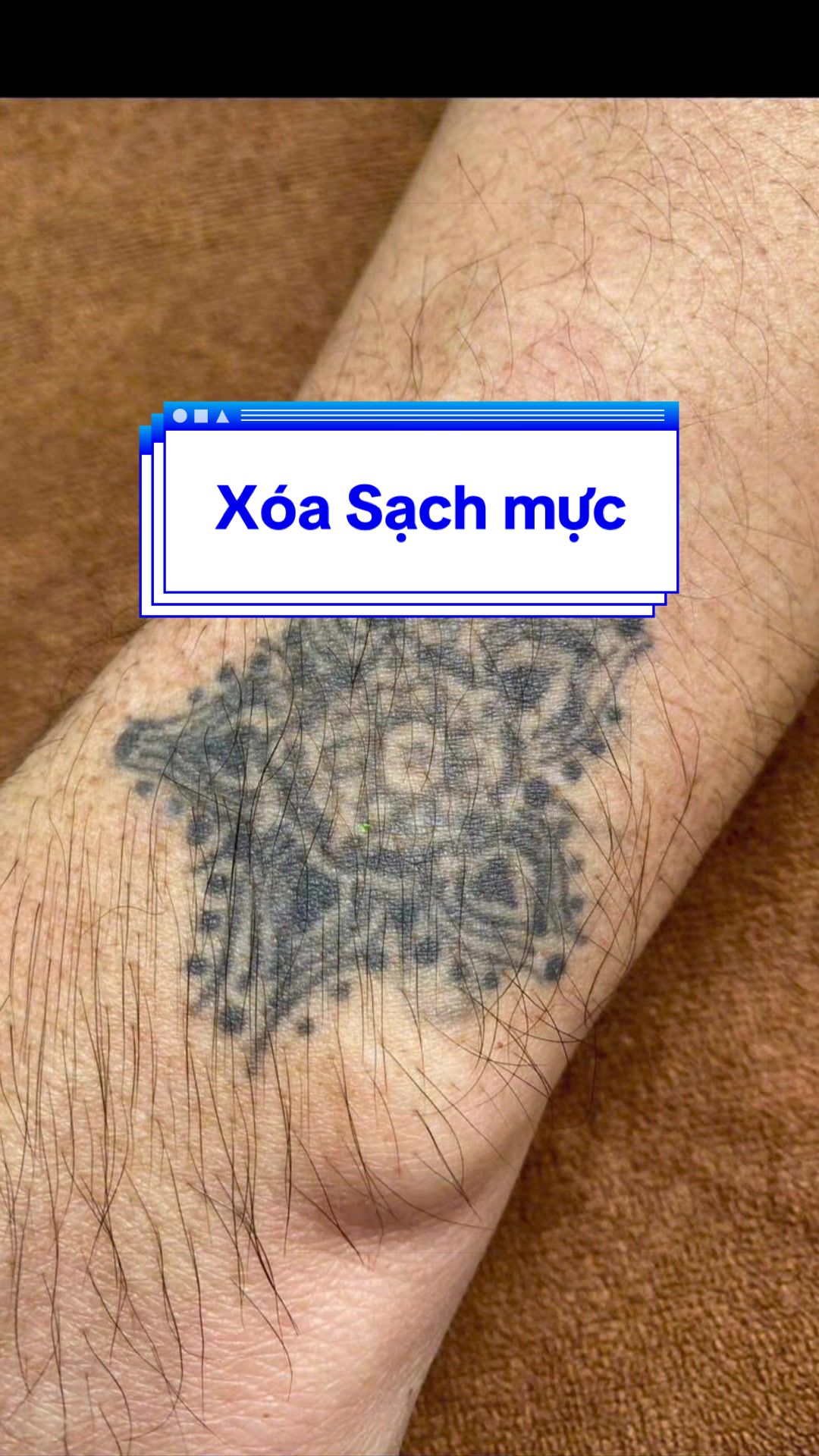 @Xo&aacute; xăm k sẹo H&agrave; Nội💧