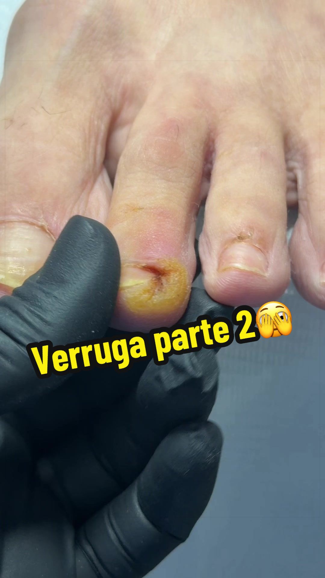 @podología calzada