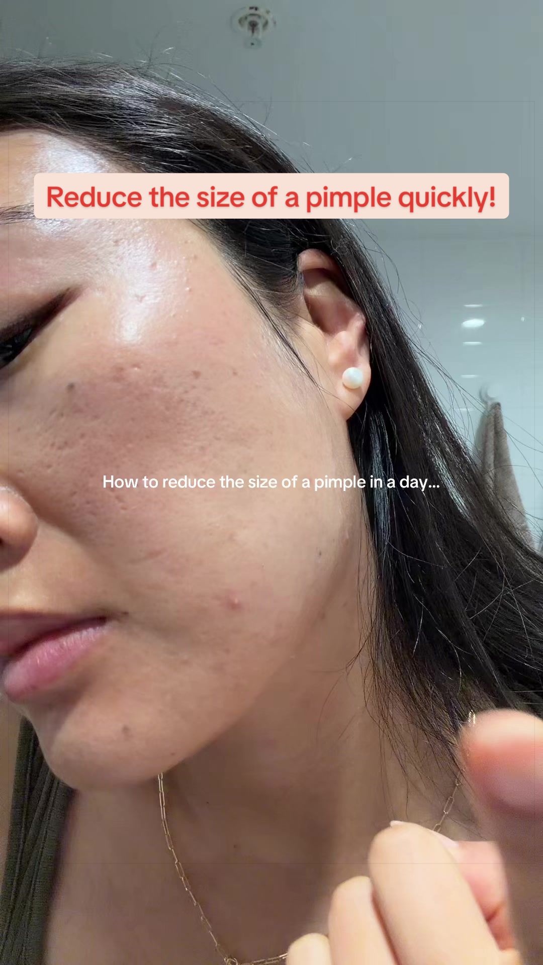@Lisa | acne → clear skin