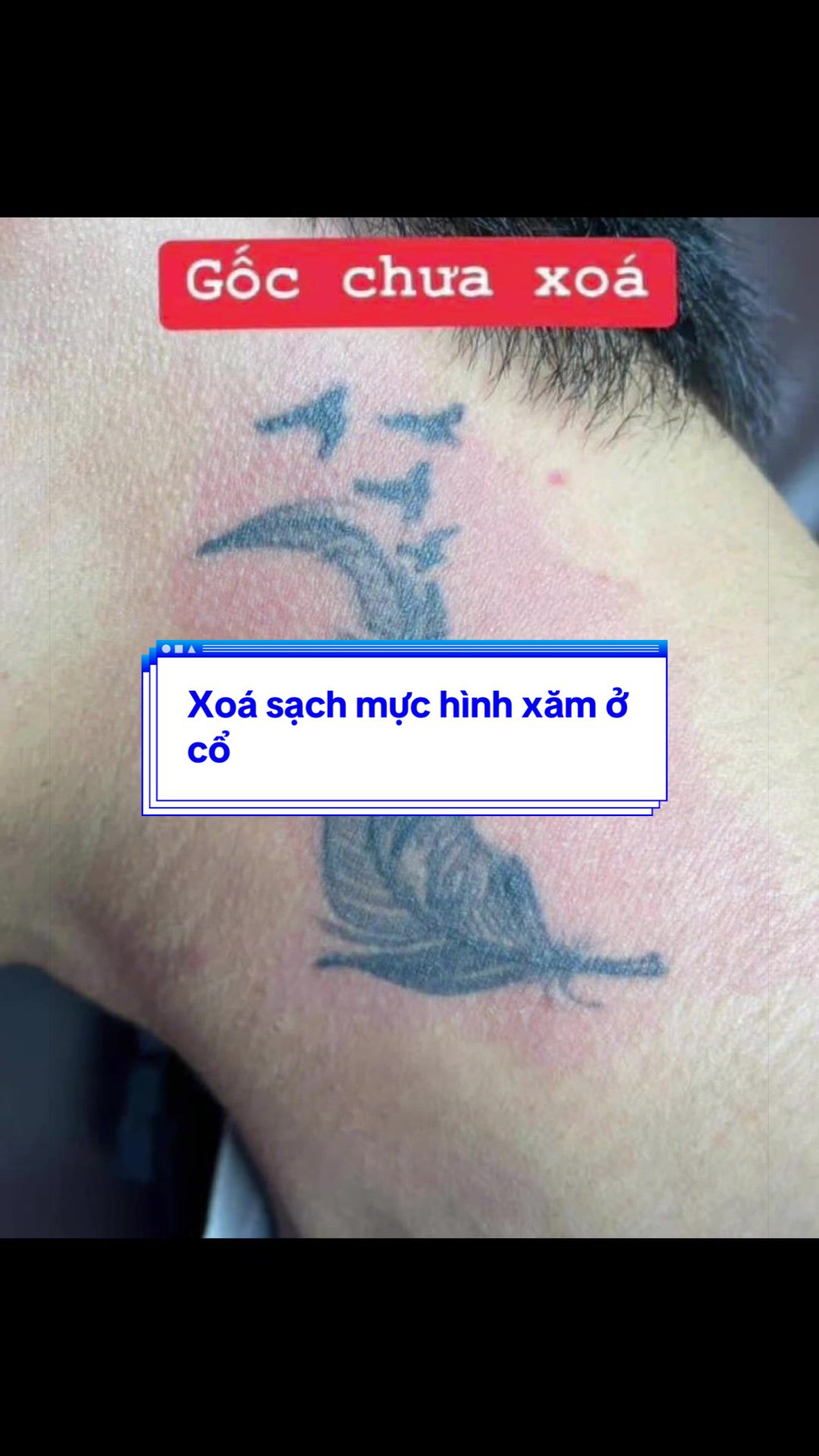 @Xo&aacute; xăm k sẹo H&agrave; Nội💧