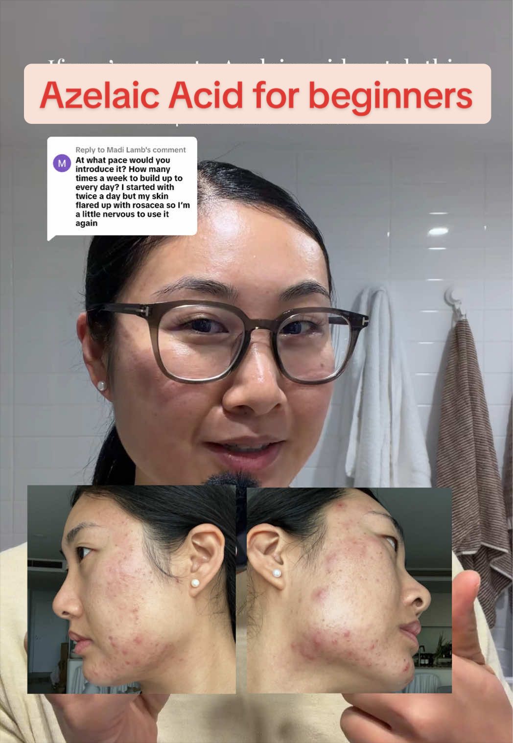 @Lisa | acne &rarr; clear skin