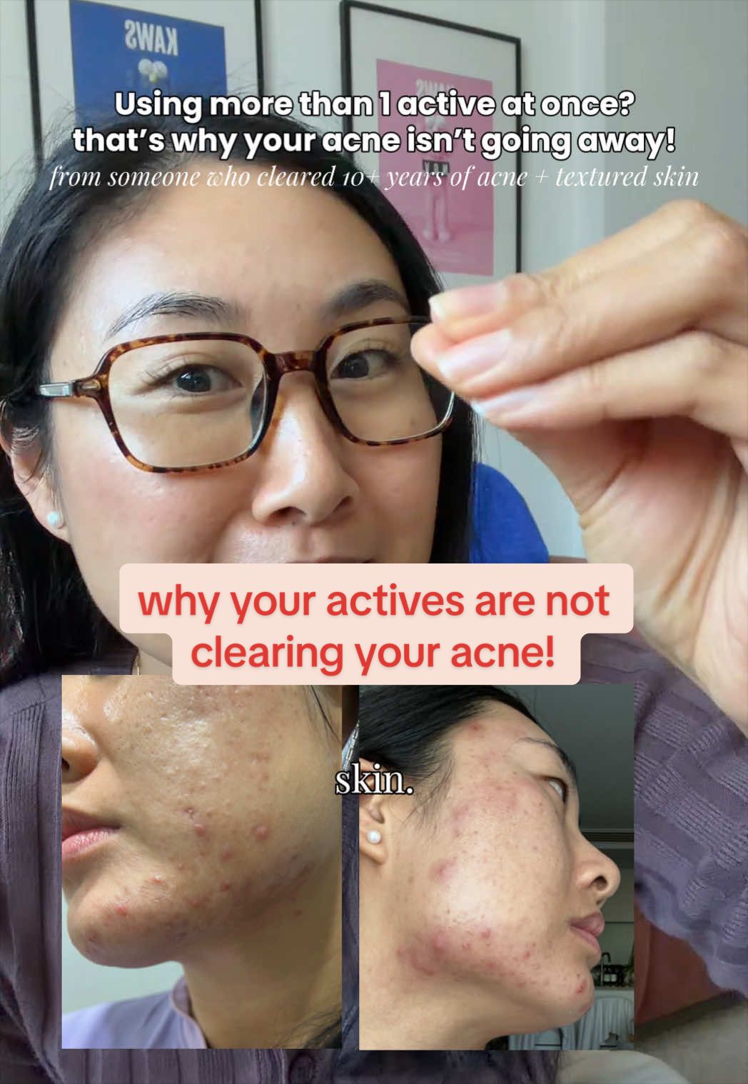 @Lisa | acne → clear skin