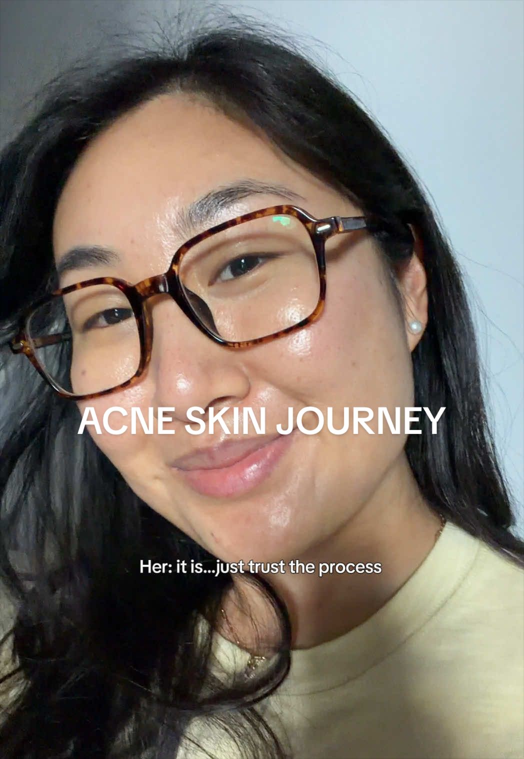@Lisa | acne &rarr; clear skin