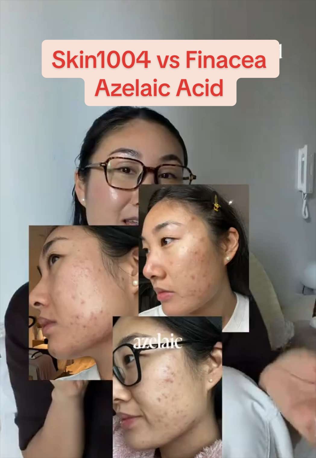 @Lisa | acne → clear skin
