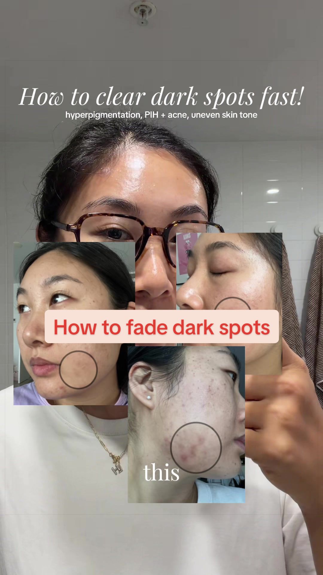 @Lisa | acne &rarr; clear skin