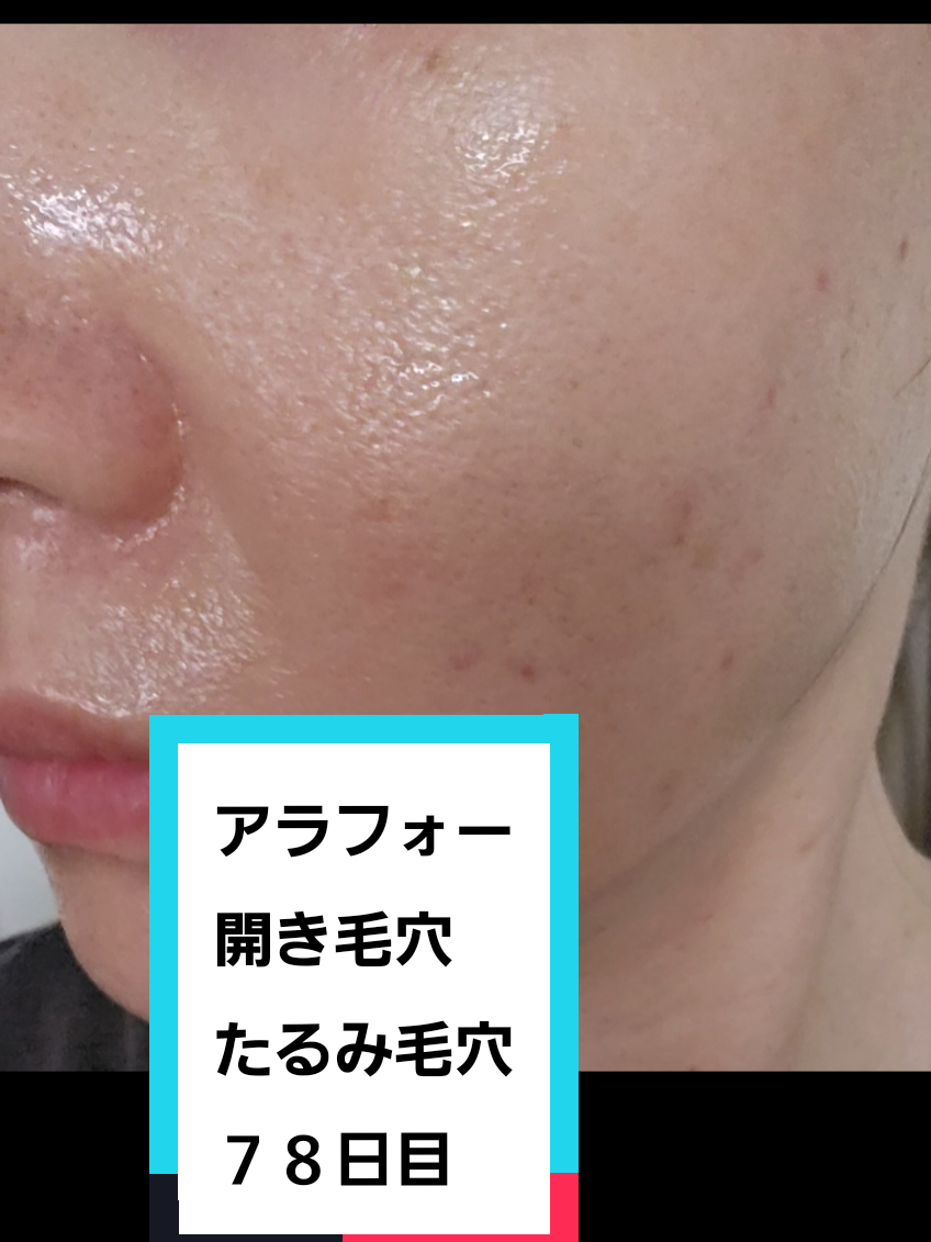 @リアル毛穴改善記録