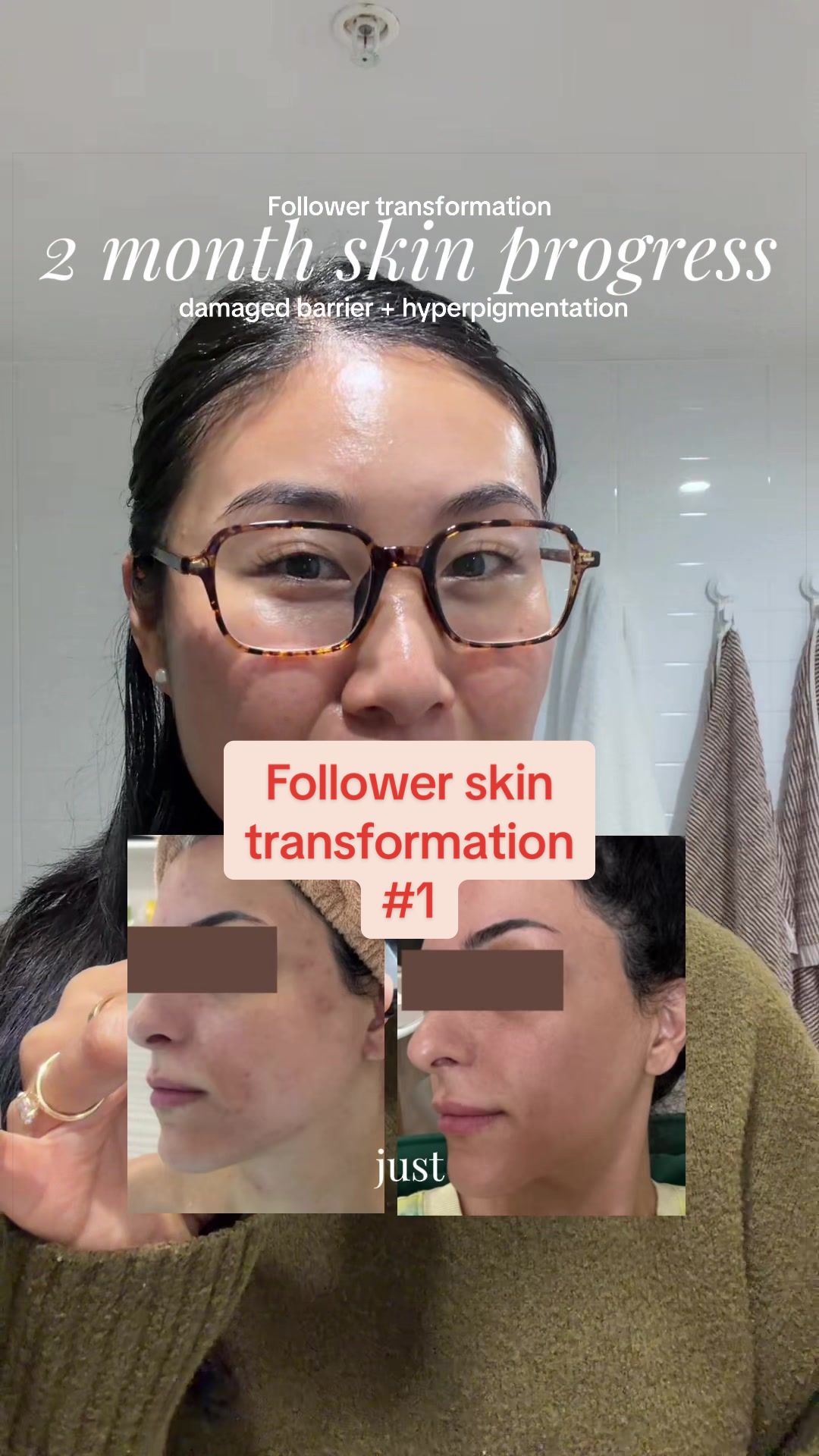@Lisa | acne → clear skin