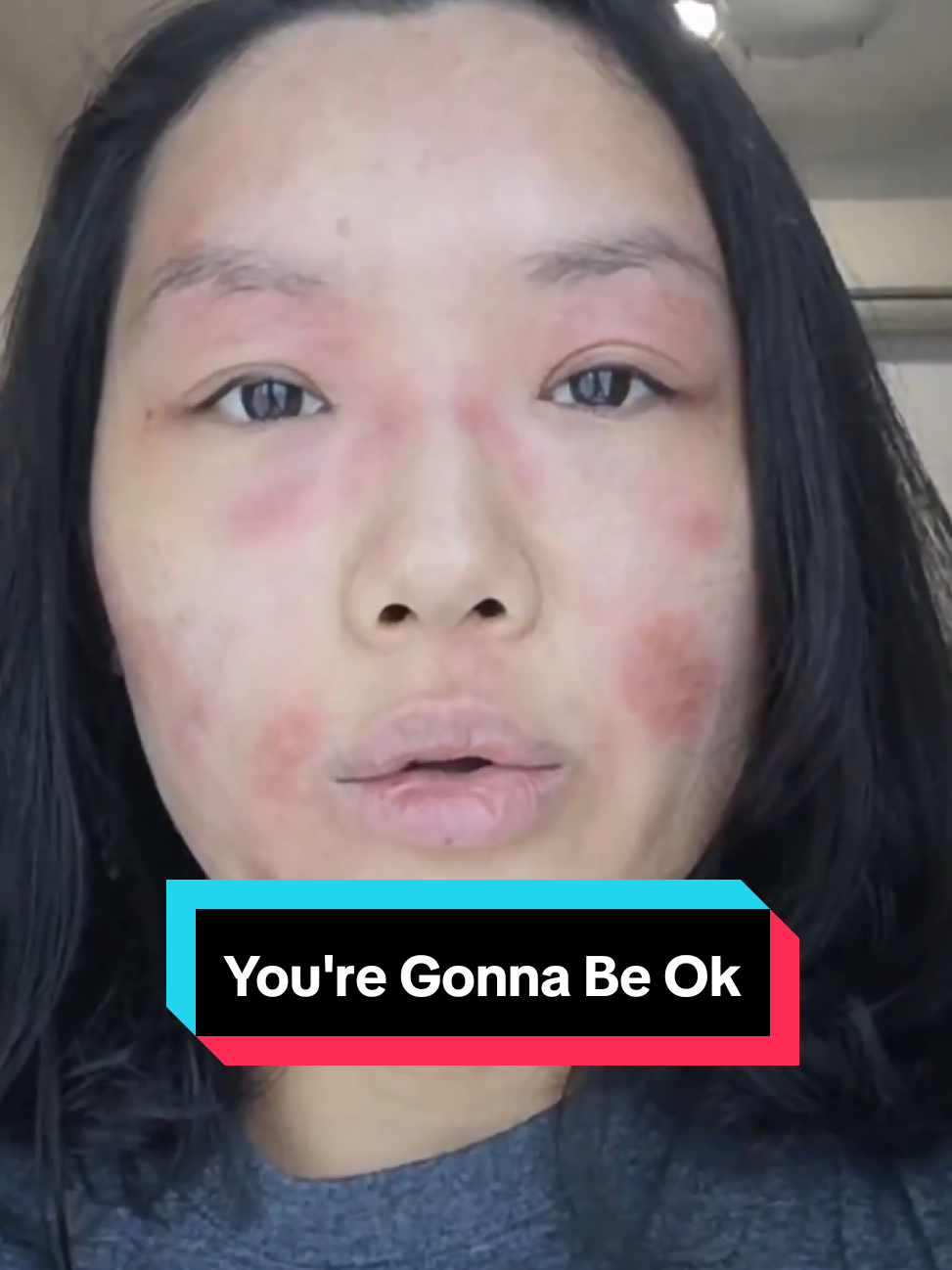 @Grace | TSW & Eczema Recovery