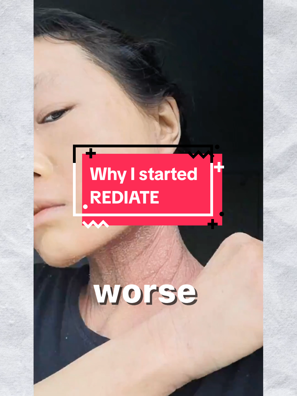 @Grace | TSW & Eczema Recovery