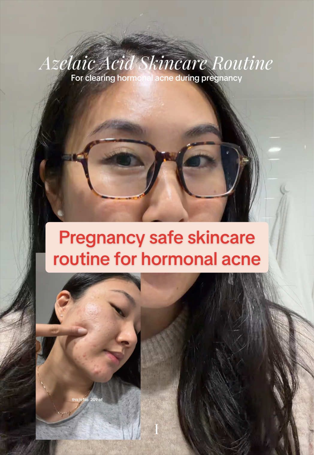 @Lisa | acne → clear skin
