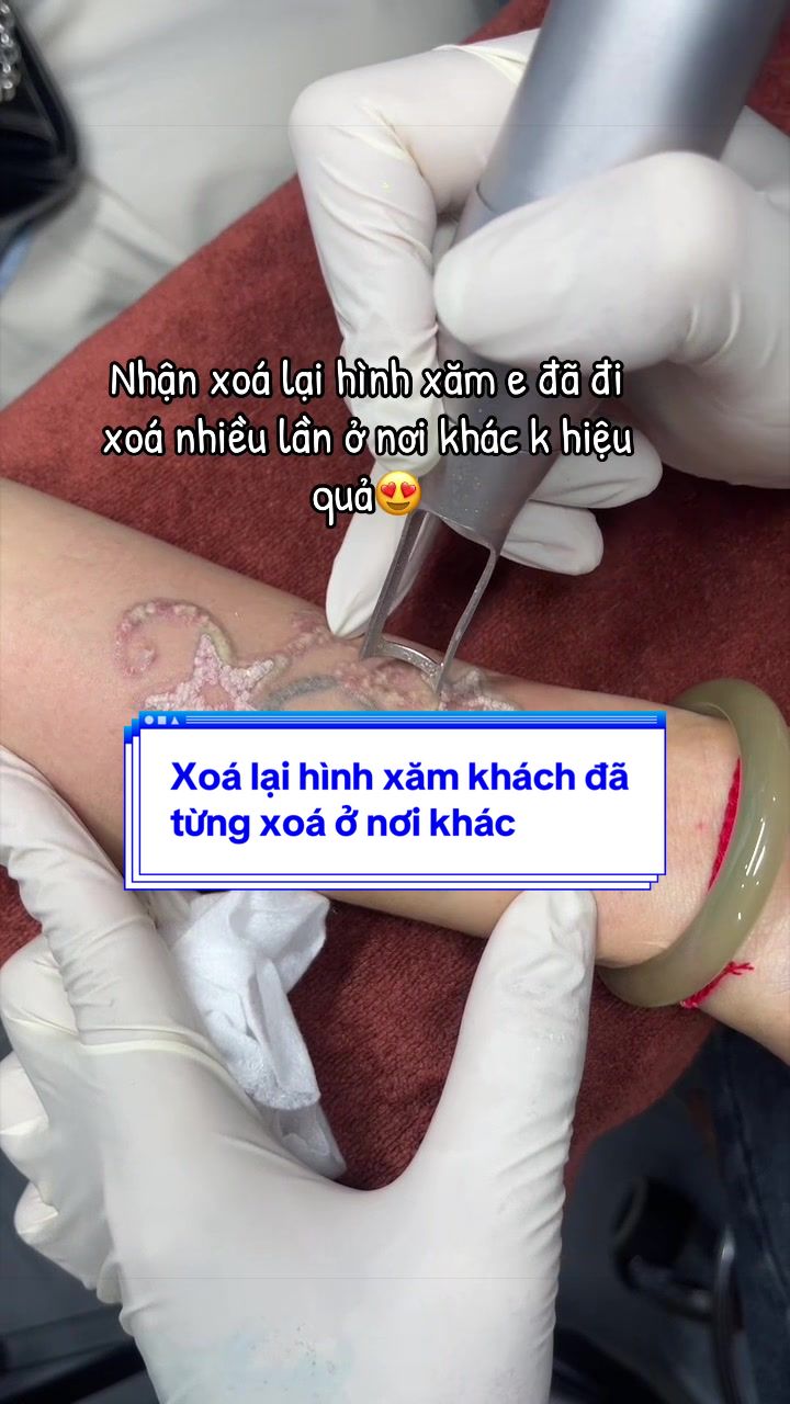@Xo&aacute; xăm k sẹo H&agrave; Nội💧