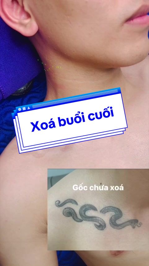 @Xo&aacute; xăm k sẹo H&agrave; Nội💧