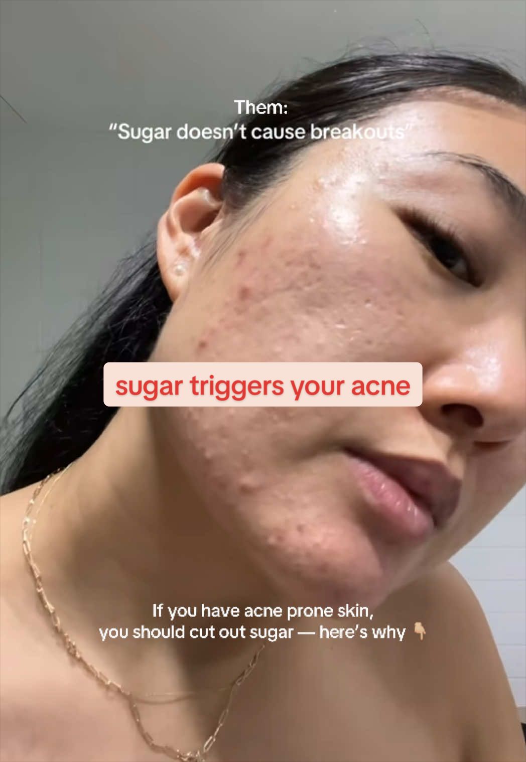 @Lisa | acne &rarr; clear skin