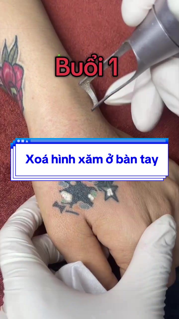 @Xo&aacute; xăm k sẹo H&agrave; Nội💧