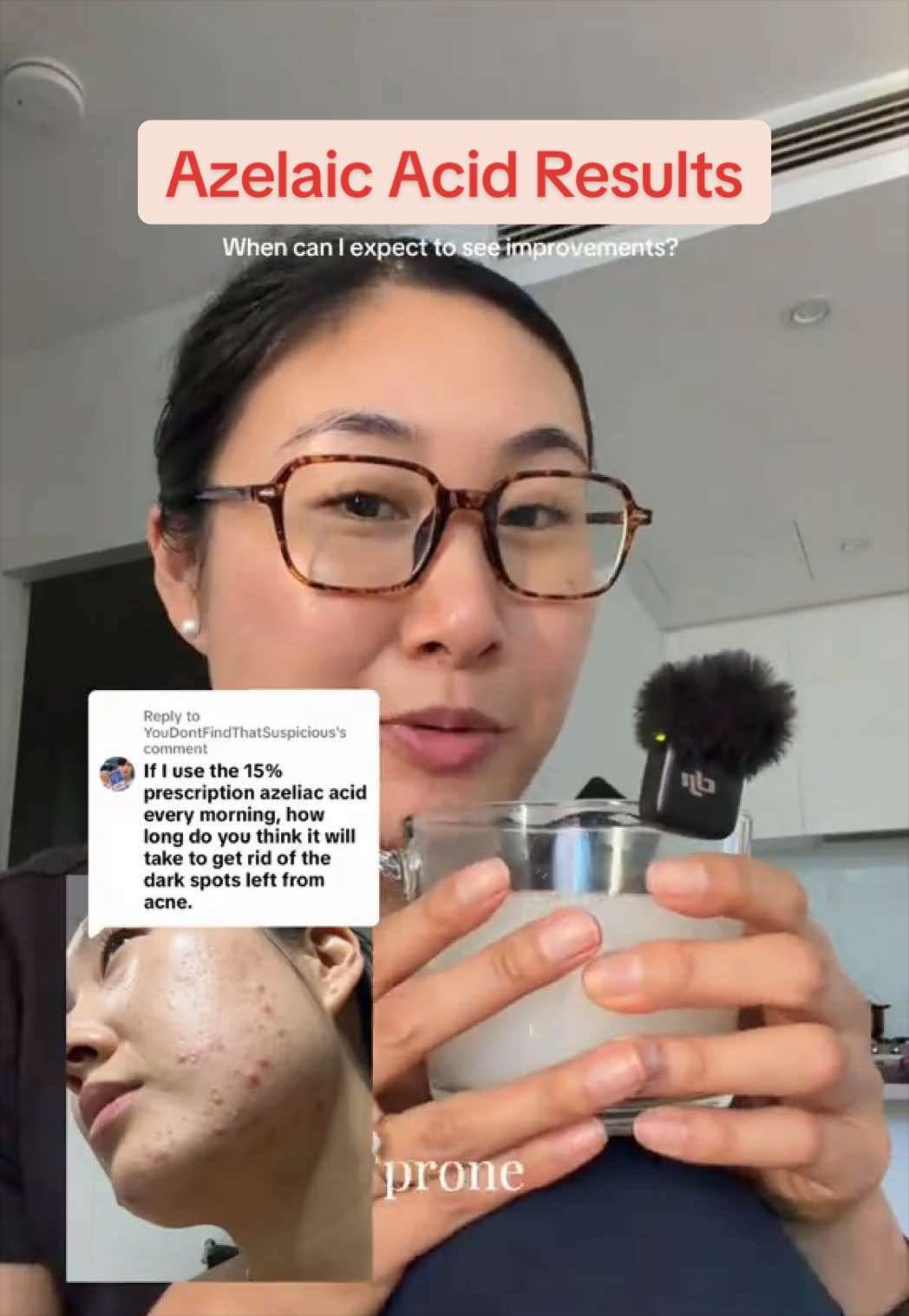 @Lisa | acne → clear skin