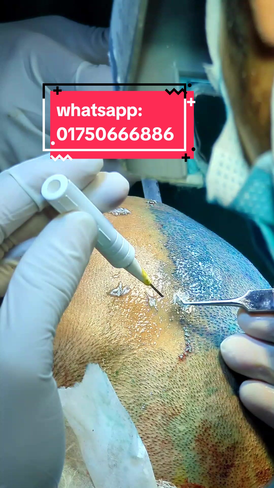 @NAZID HAIR TRANSPLANT