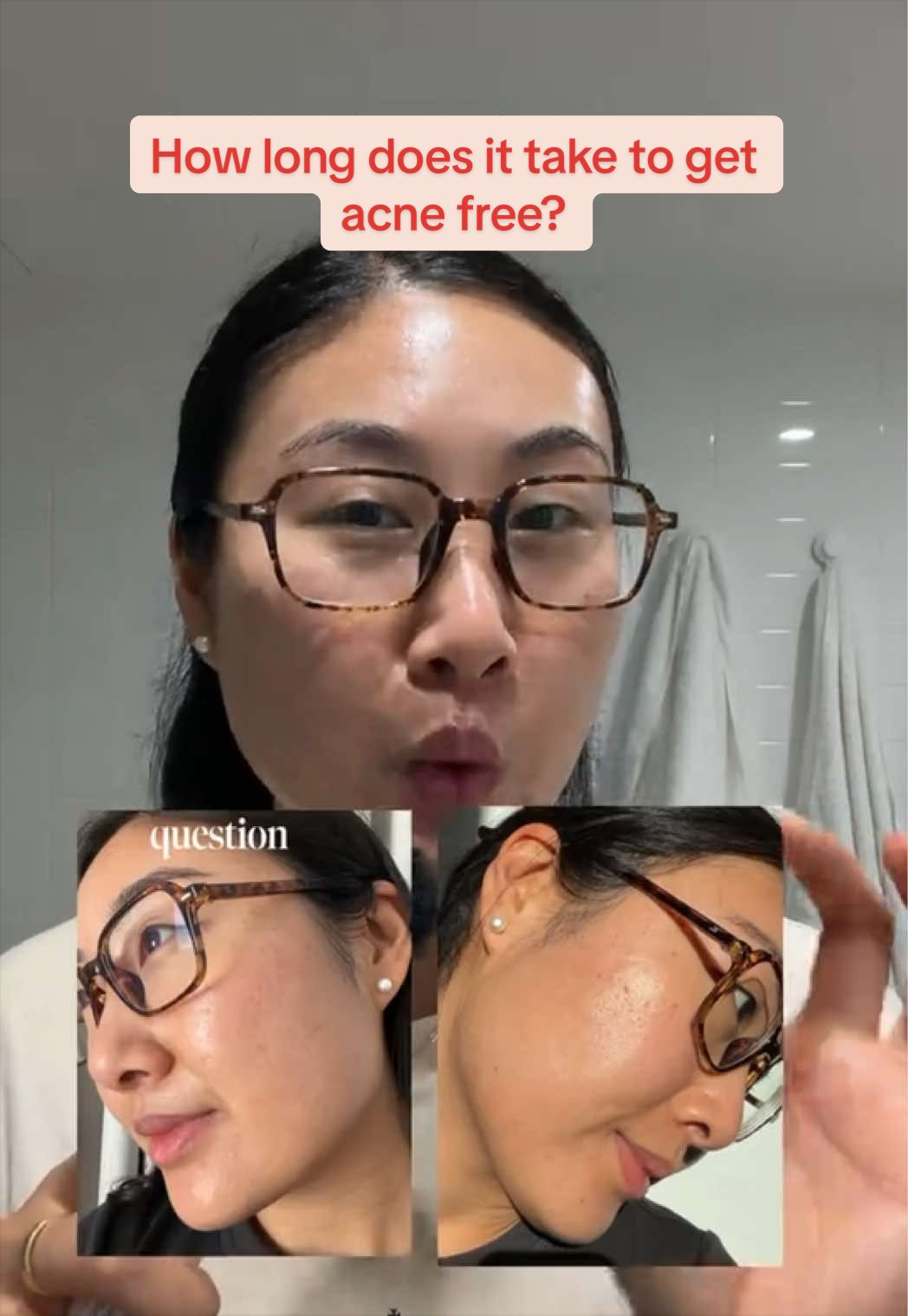 @Lisa | acne → clear skin