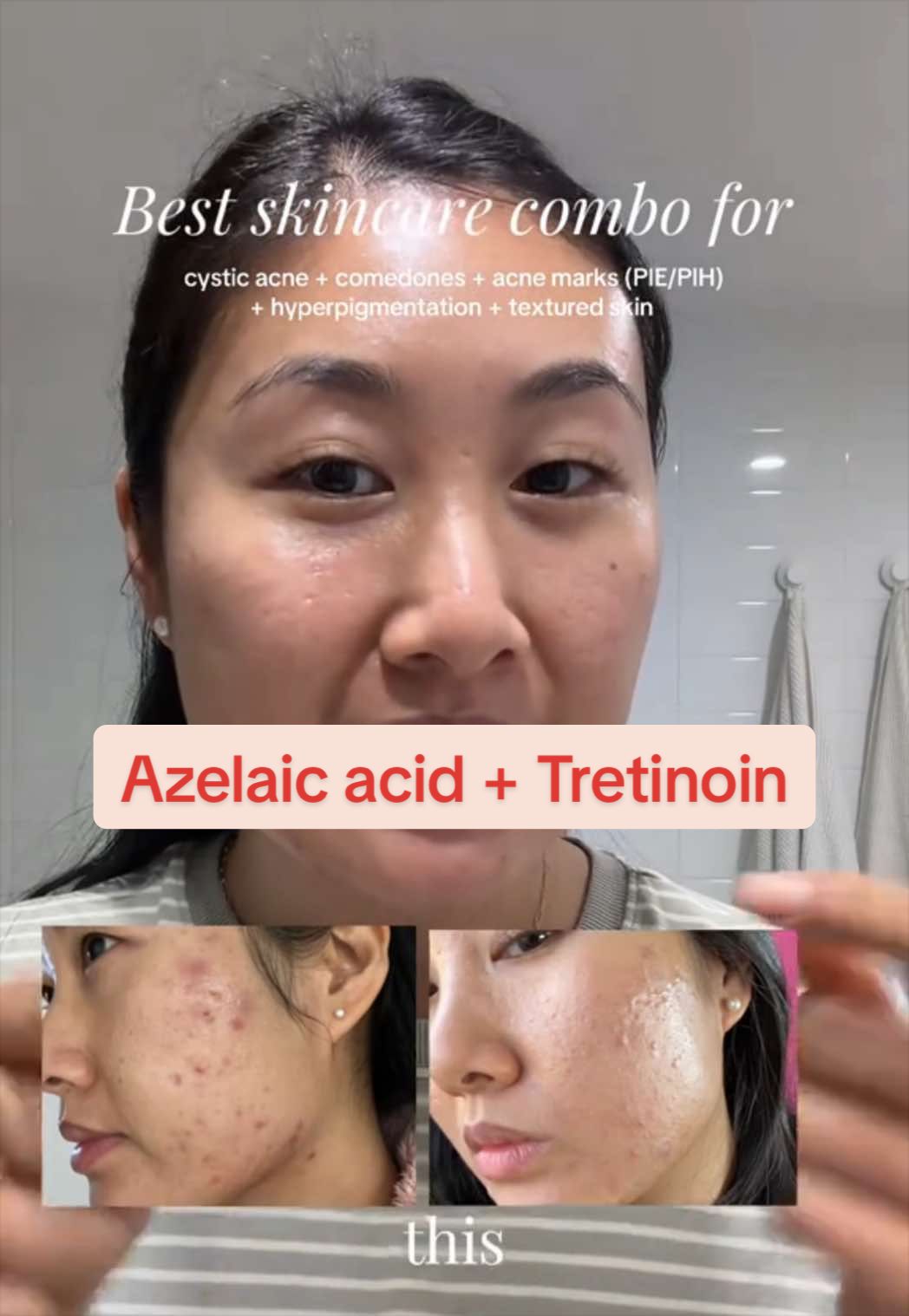 @Lisa | acne &rarr; clear skin