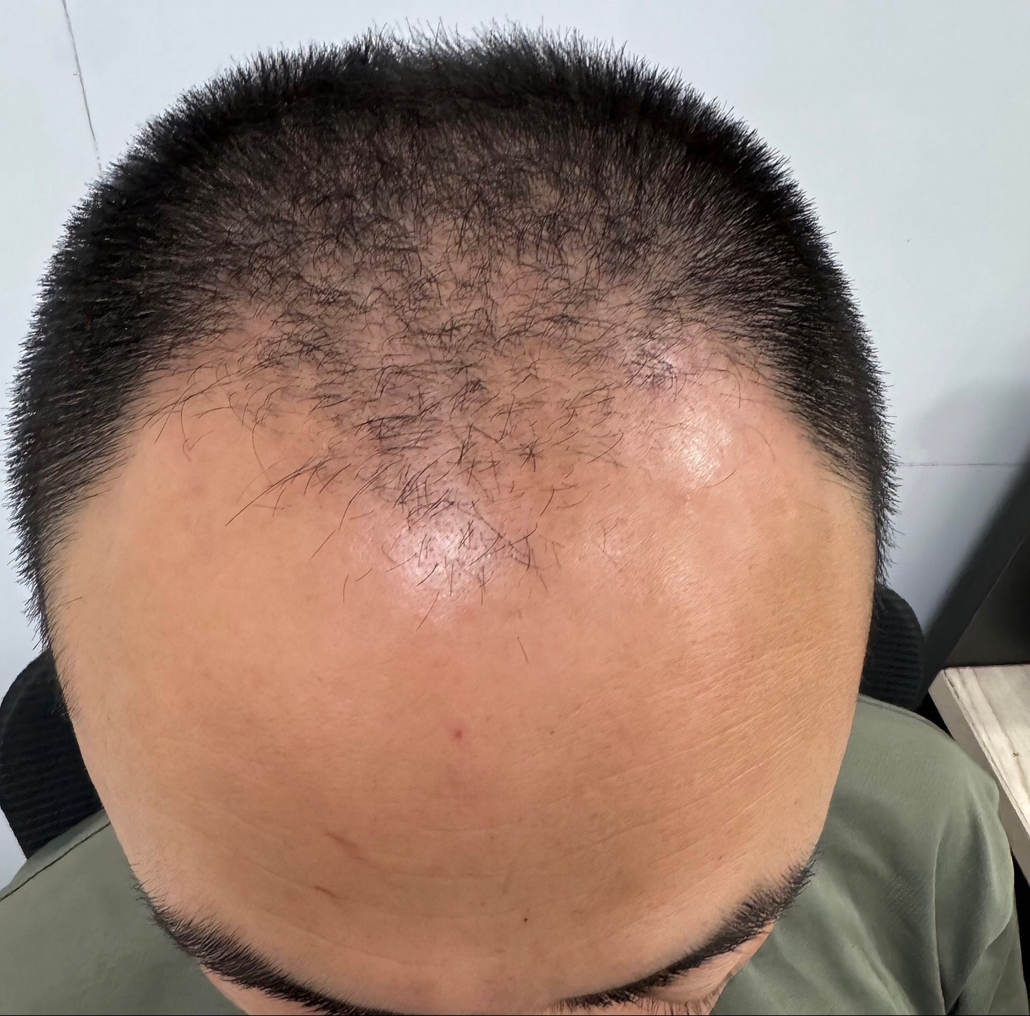 @HAIR TRANSPLANT WANG🇨🇳
