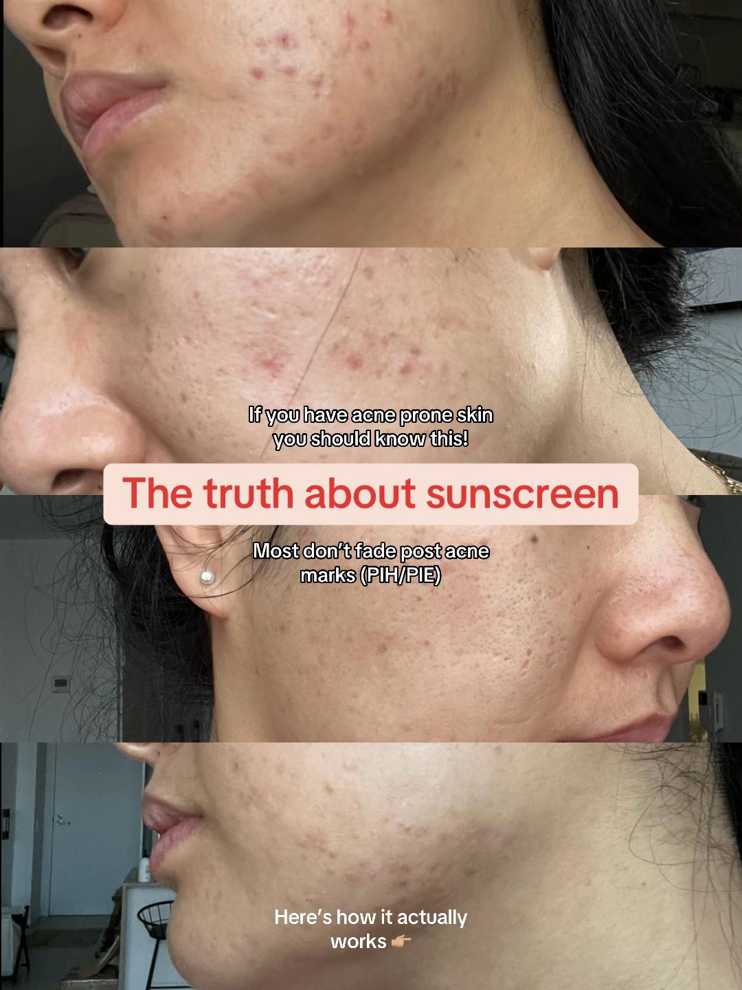 @Lisa | acne → clear skin