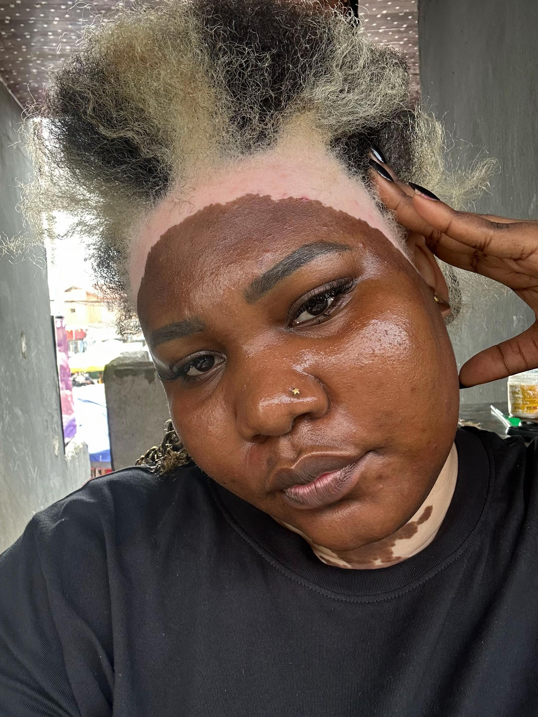@Thevitiligogirl