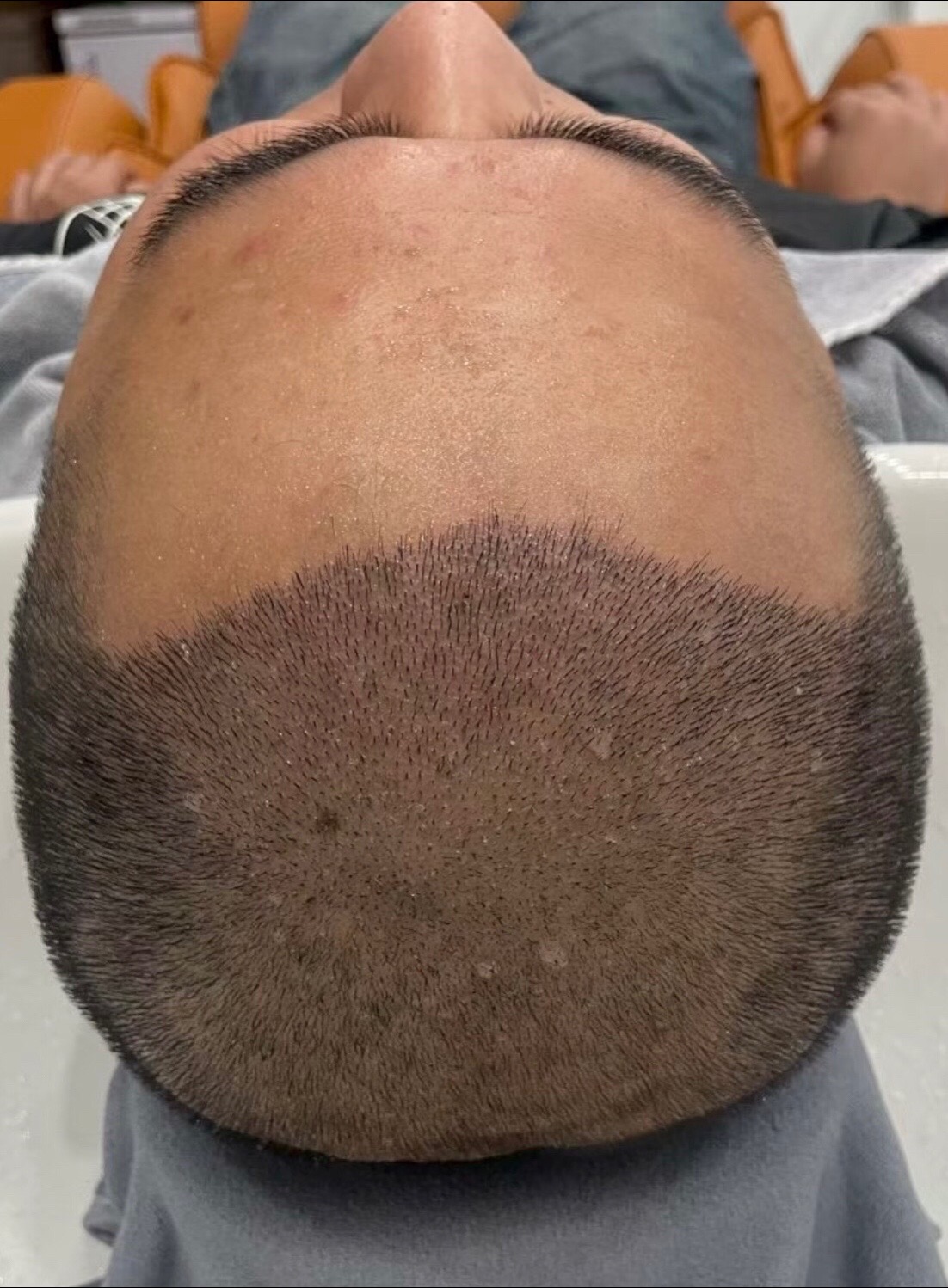 @HAIR TRANSPLANT WANG🇨🇳