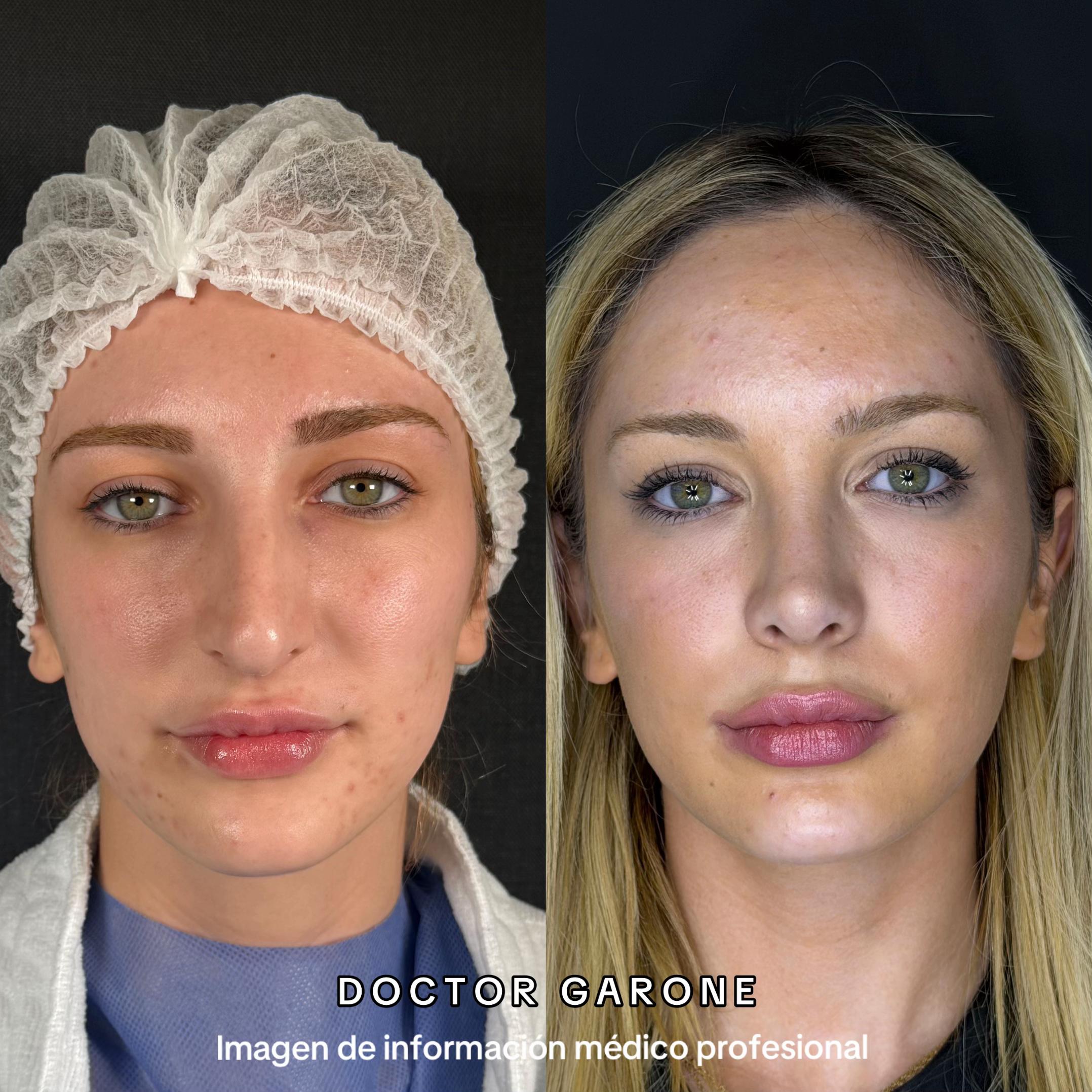 @drgarone.rinoplastia
