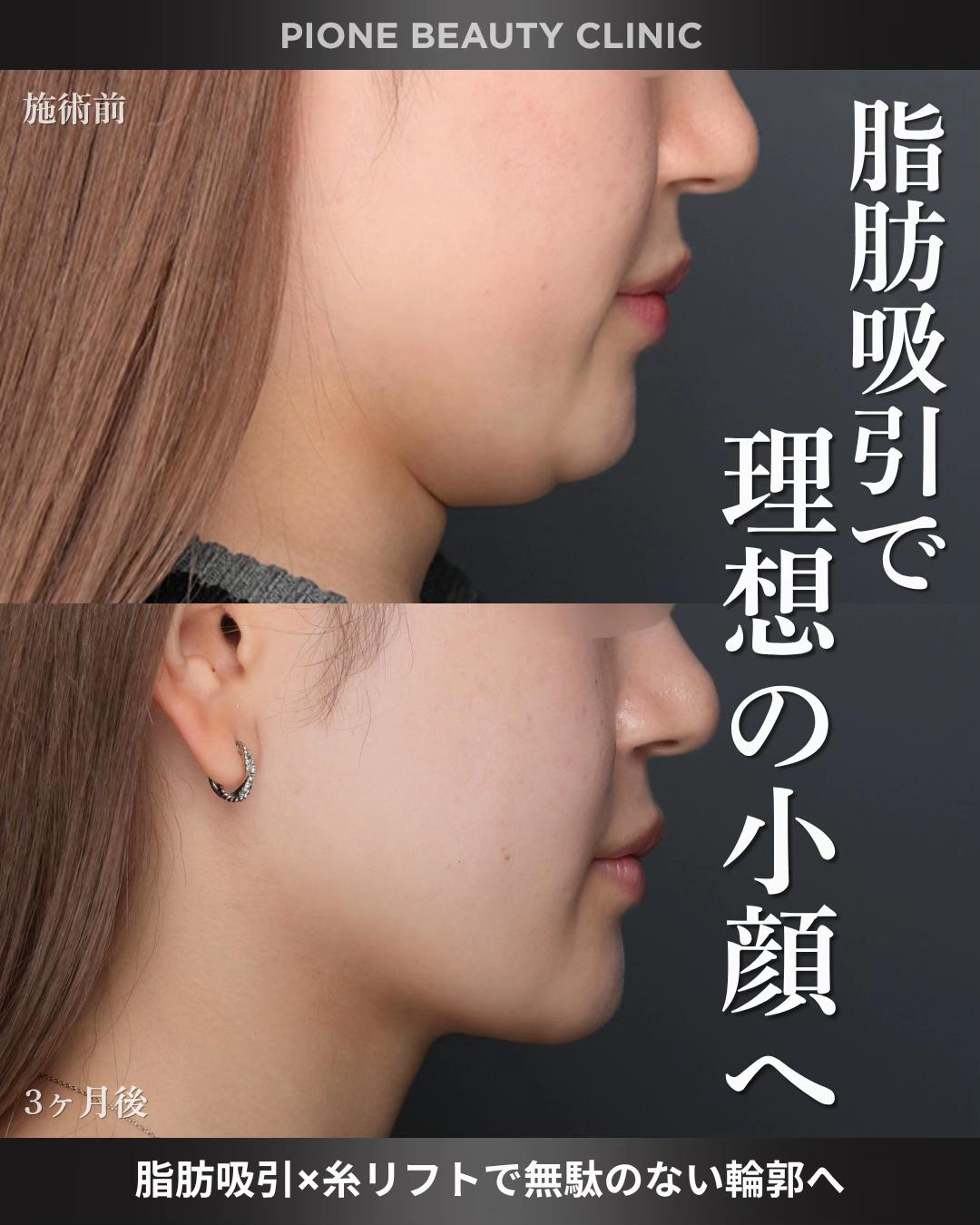 @金澤紀臣【小顔/若返り/脂肪吸引】