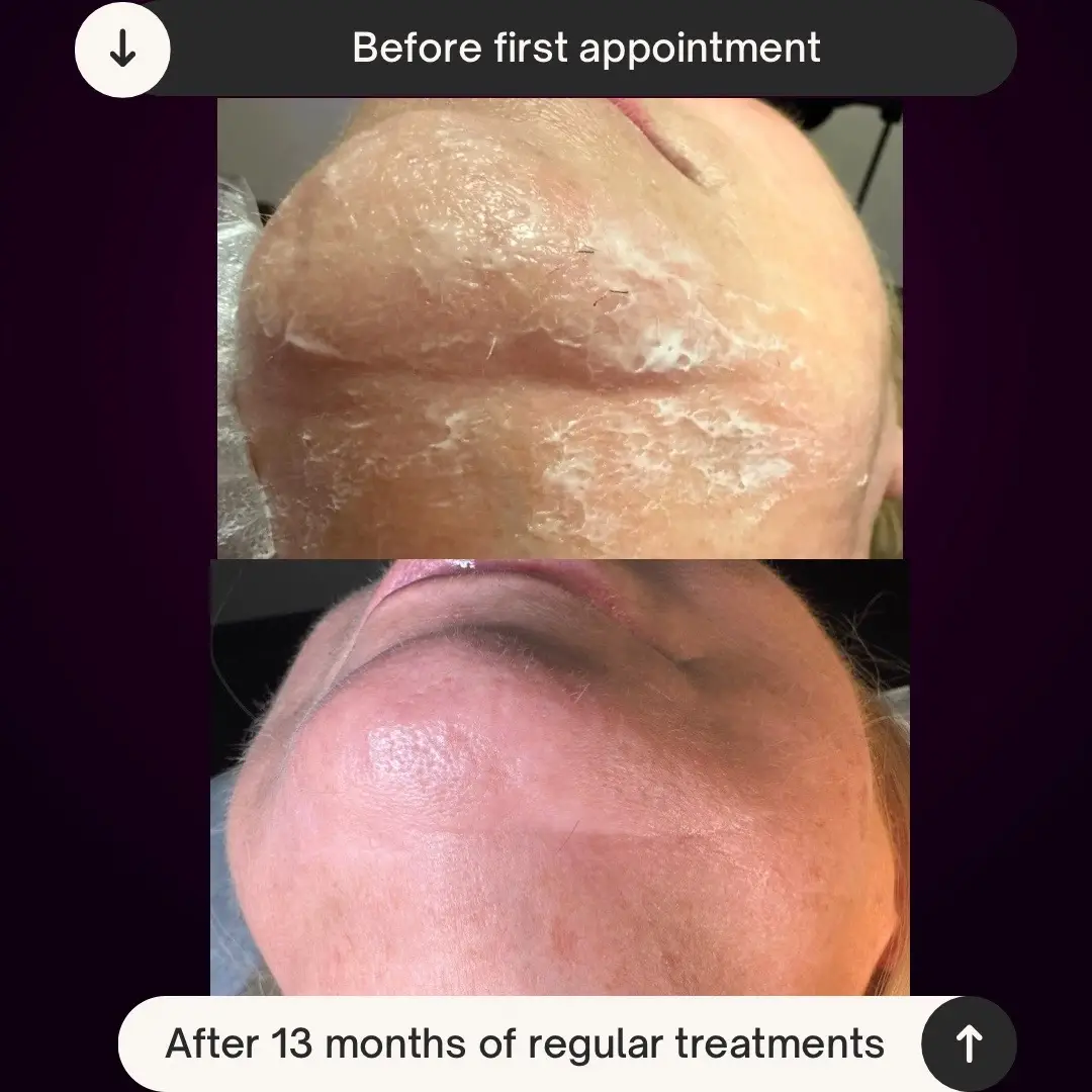 @Neurospice Beauty Electrolysis