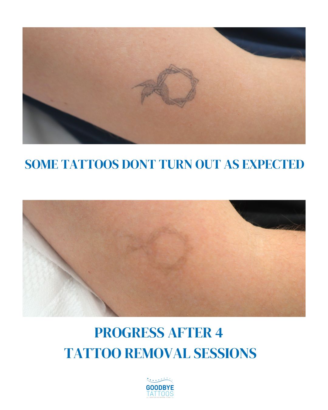@Jamie T| Tattoo Removal Expert